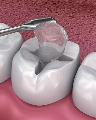 Cavity filling