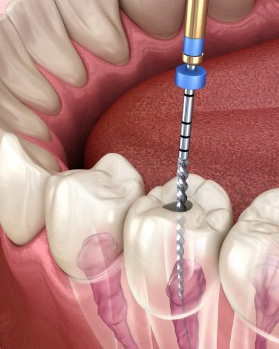 Root canal treatment
