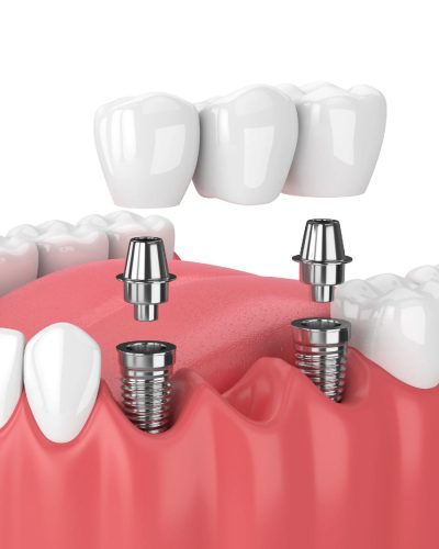 Teeth work-21