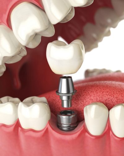 Teeth work-24